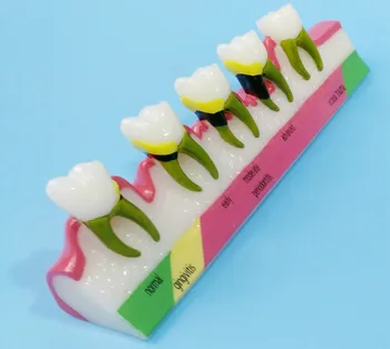 

Colored Human Oral Teeth Model Periodontal Disease Model Teeth Pathology Model Medical Teaching Aids Dentist Teaching Equipment