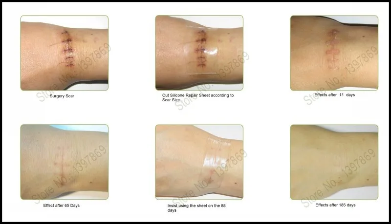 1pc free shipping silicone scar remove patch to remove scar trauma scaraway sheets review