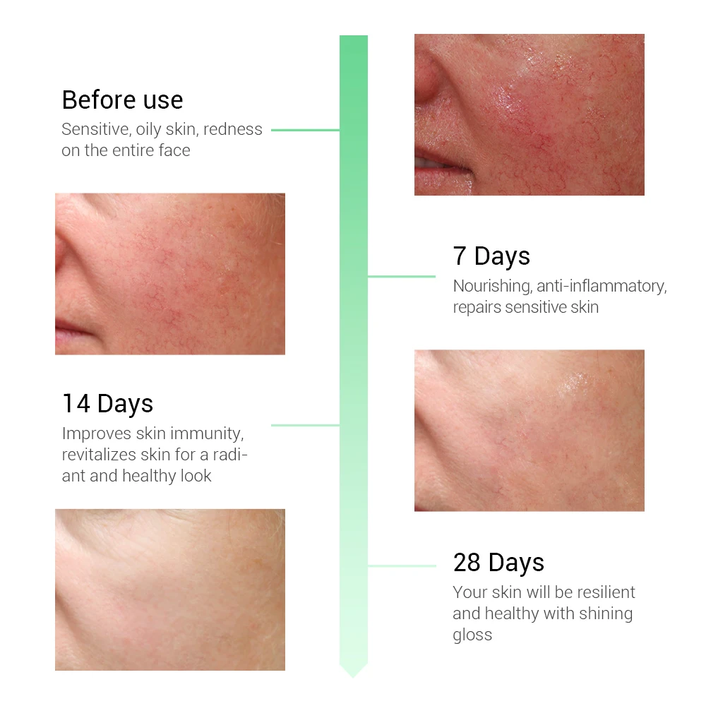 Breylee Soothing Repairing Serum Repair Sensitive Skin Remove Redness Face Skin Care Acne Scar Removal Snail Serum Beauty 10pcs Breylee Soothing Repairing Serum Repair Sensitive Skin Remove Redness Face Skin Care Acne Scar Removal Snail Serum Beauty 10pcs