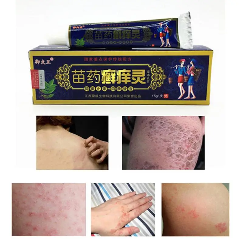 

Natural Skin Care Antipruritic Body Psoriasis Cream Dermatitis Eczema Pruritus Psoriasi With Retail Box Beauty Body Skin Care
