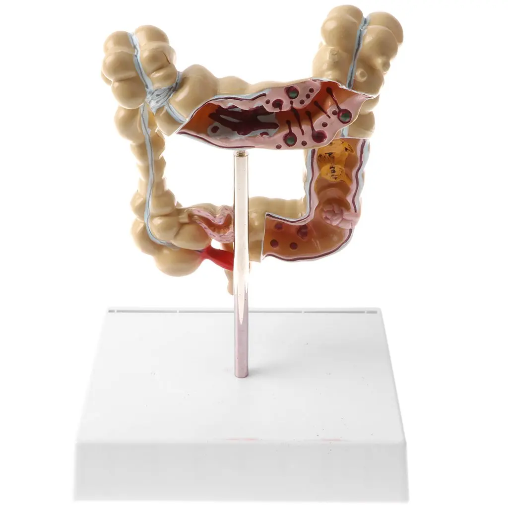  1: 2 Human Large Bowel Pathological Model Medical Anatomical Model for School Teaching Tool Learnin - 32973576715
