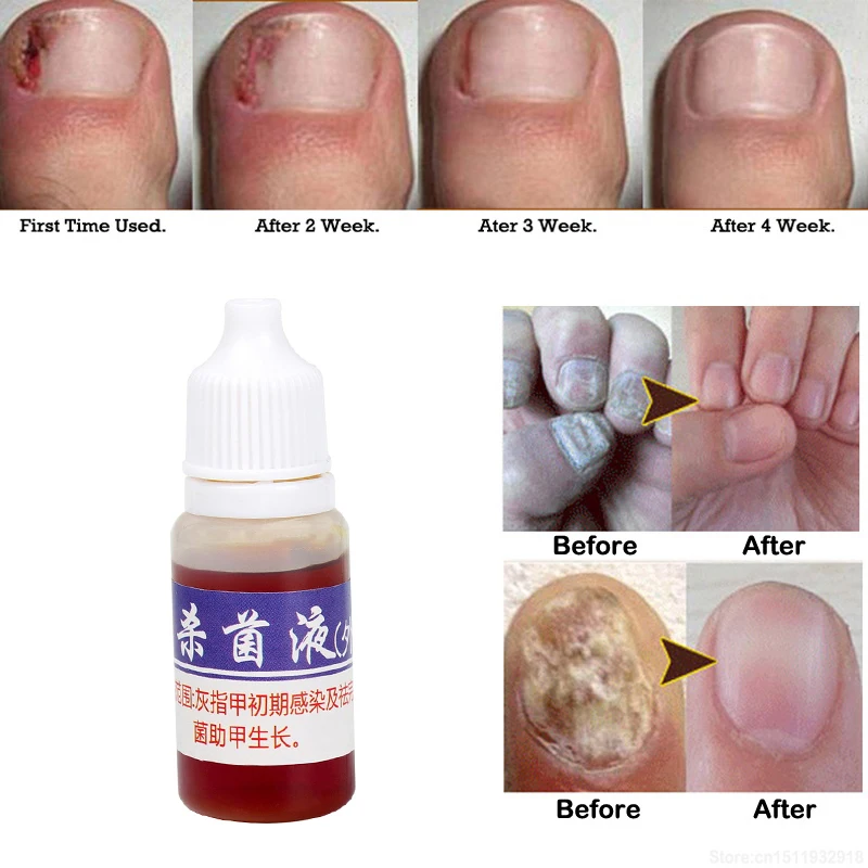 

10ml Liquid Nail Infection Repair Pen Onychomycosis Anti Fungal Toe Fungus Treatment Toe Finger Nail Health Accessories TSLM1