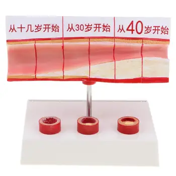 

Human Arteriosclerosis Vessels Model Medical Anatomical Model for School Teaching Tool Learning Display Lab Supplies