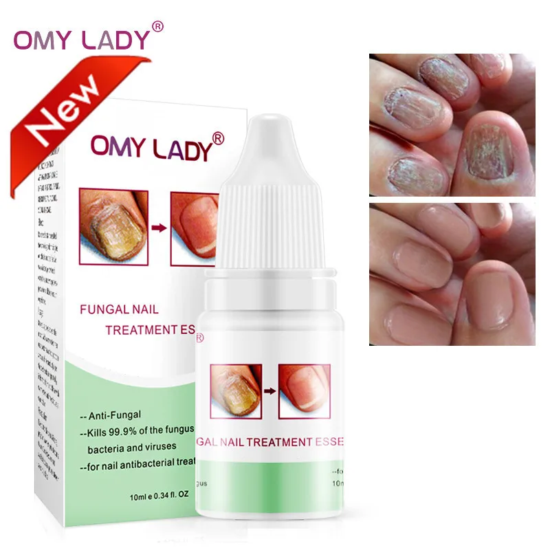

OMYLADY New Nail Repair Essence Serum Fungal Nail Treatment Remove Onychomycosis Toe Nourishing Brighten Hand Foot Skin Care