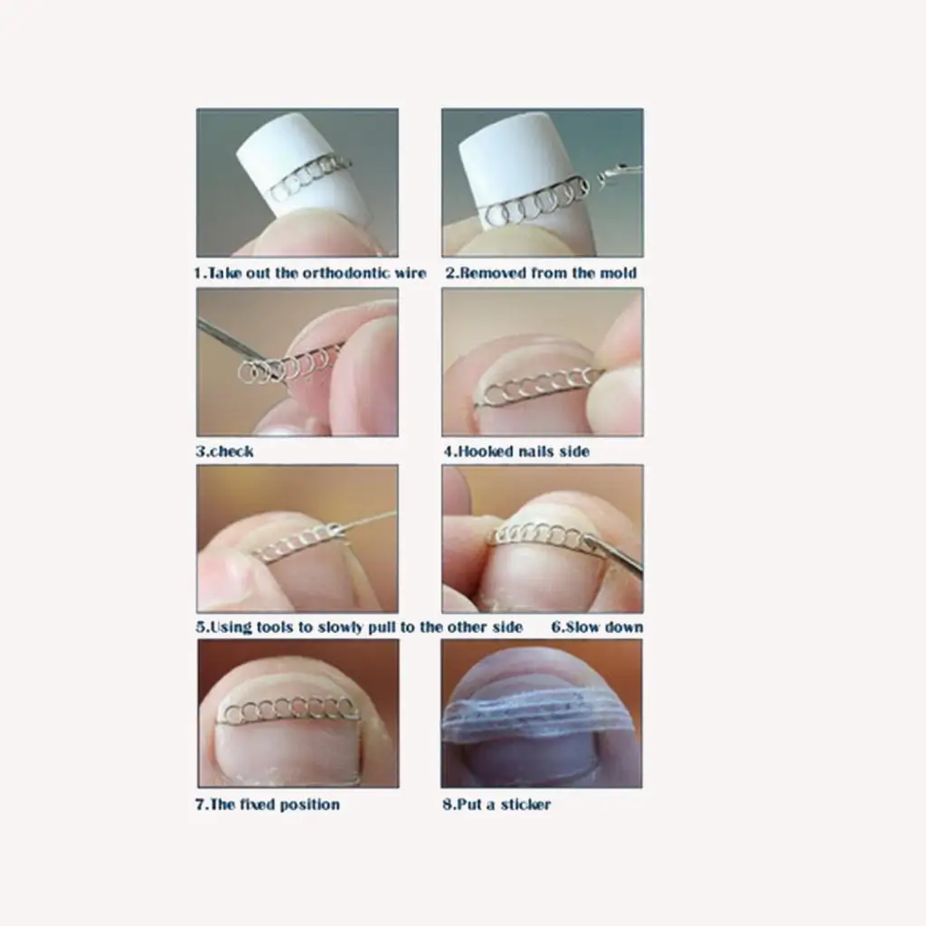 Kesoto Ingrown Toe Nail Correction pro Foot Nail Orthotic Manicure Toenail Corrector Stickers Bunion Corrector Foot Care Tools