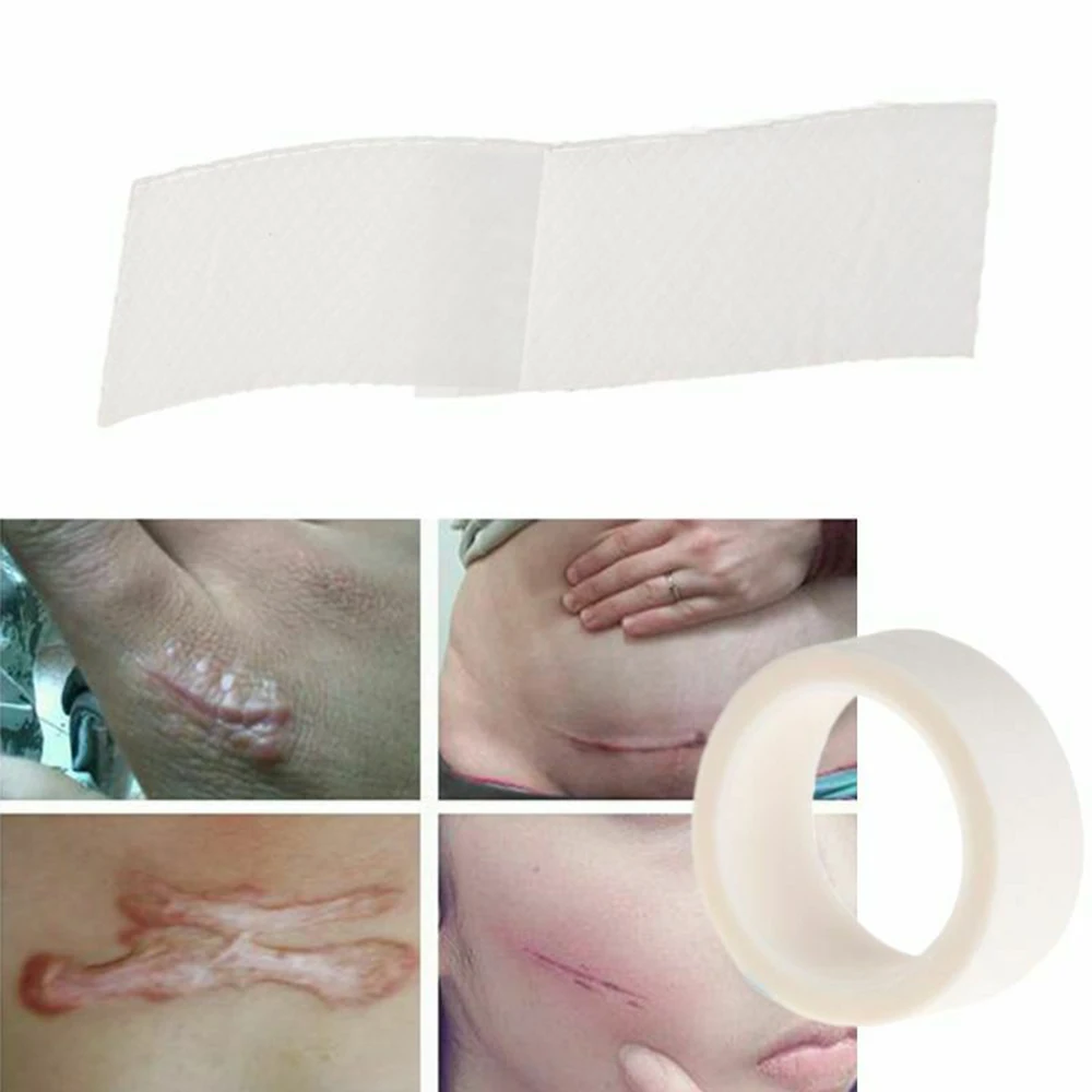 

Burn Scar Treatment Sheet Tape Reusable Therapy Patch for Acne Trauma Skin Repair Removal Scar Sheet Repair Silicone Gel