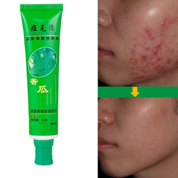 

30g Face Removal Acne Cream Pimple Spots Scar Treatment Adult Skin Care Repair