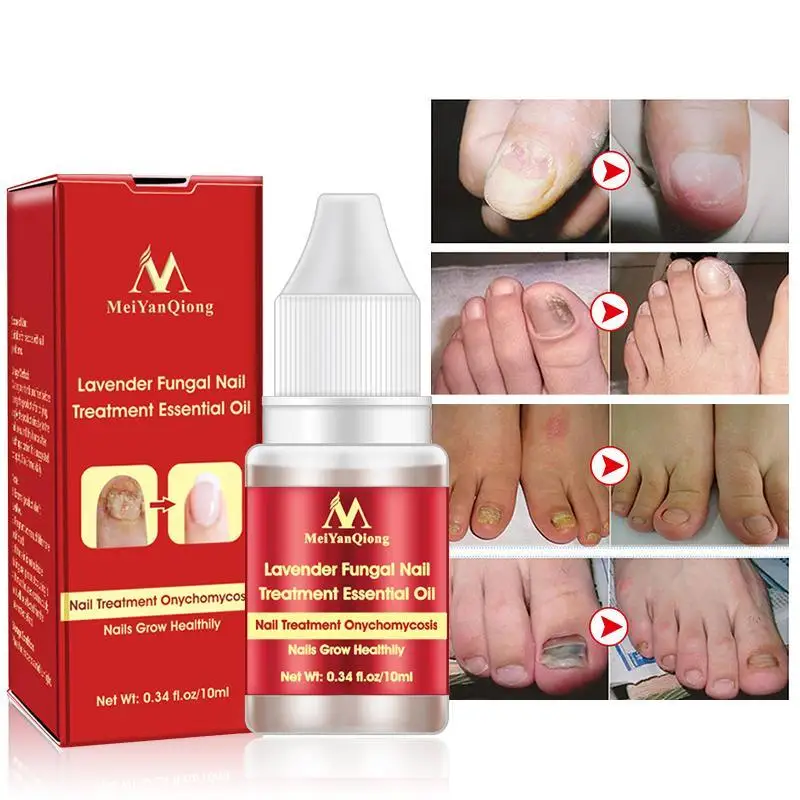 Buy 10ml Nail Fungus Treatment Anti Fungal Toenail