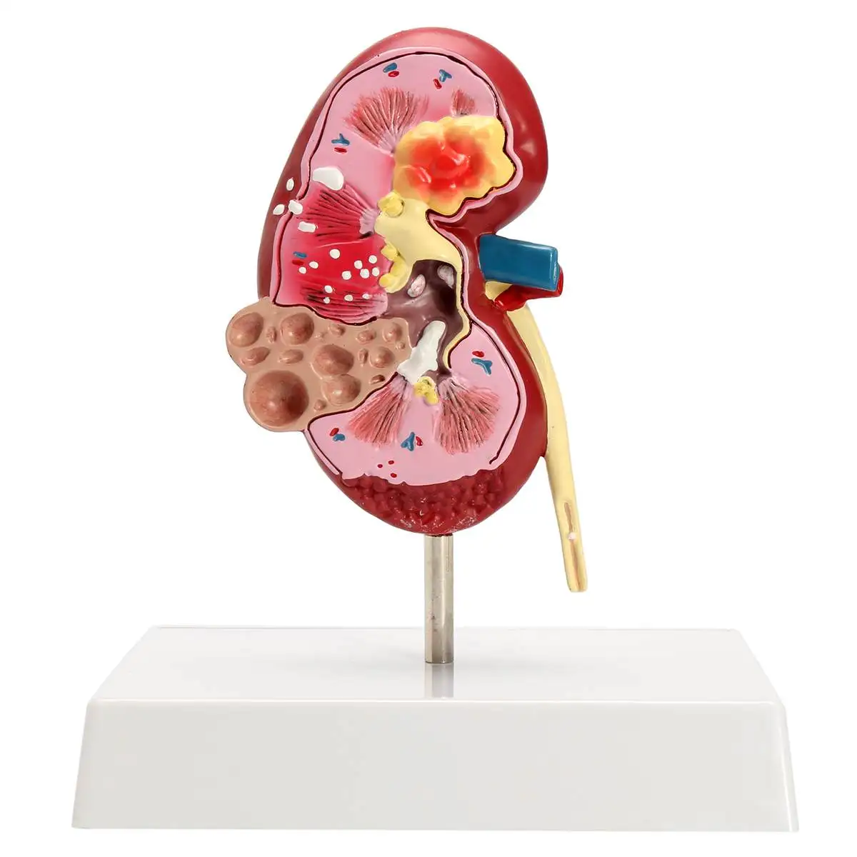 

20x18x14cm Medical Kidney Anatomical Model School Educational Medical Science 2-sided Diseased Anatomy Teaching Learning Model
