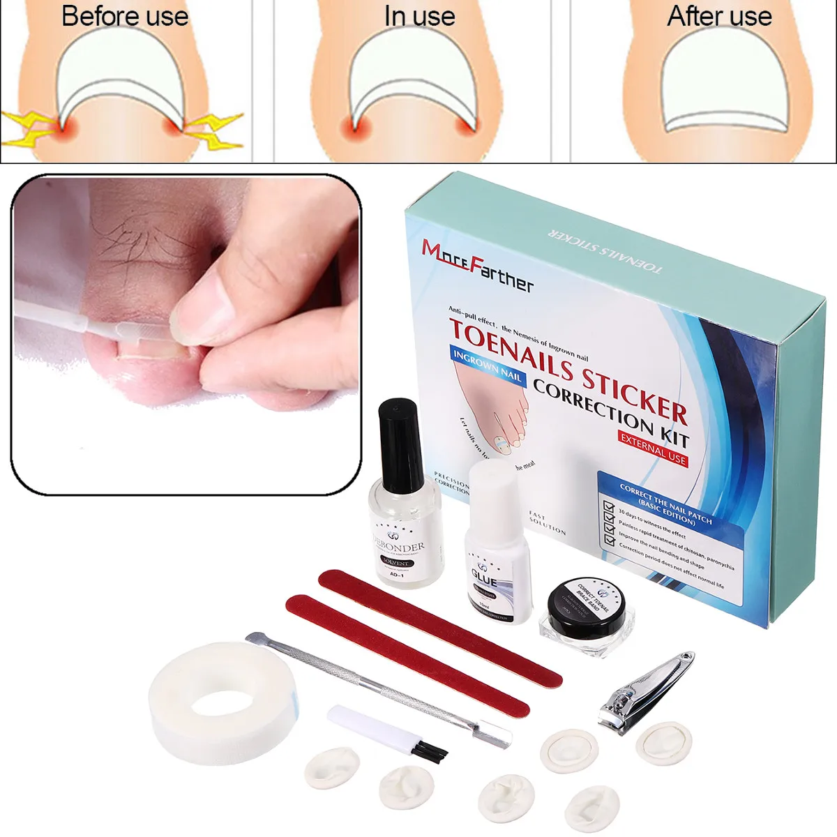 Ingrown Toenail Ingrown Toenail Pedicure Tool Set Straightening Clip