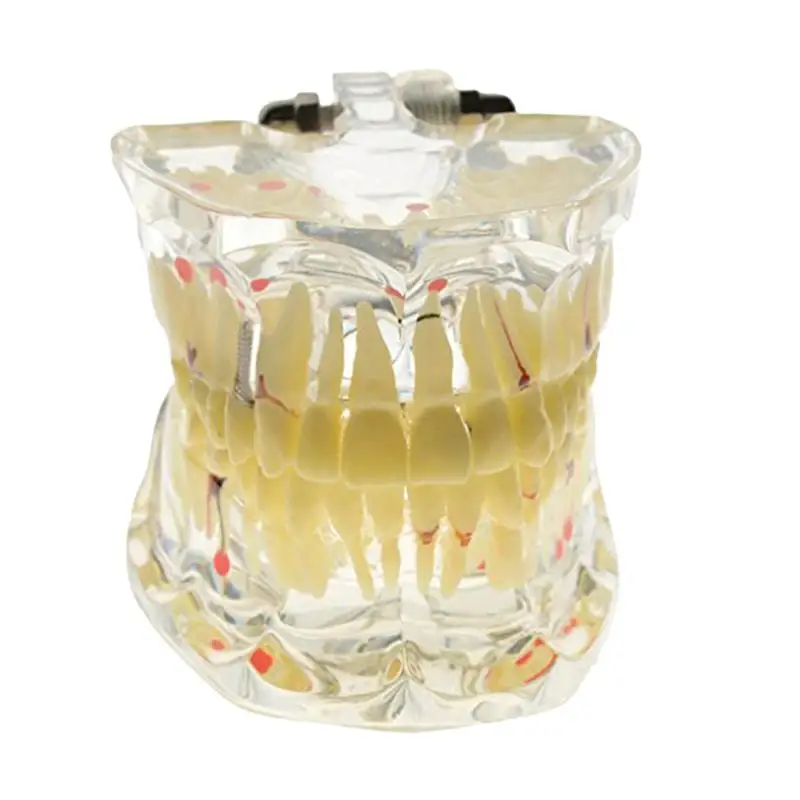 

Detachable Oral Model Removable Dental Implant Disease Teeth Model Human Teeth Disease Teaching Teeth Model