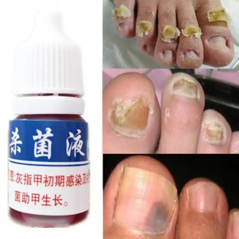 10 мл Высокое качество ремонт ногтей Onychomycosis Remover грибок грибковая Жидкость против
