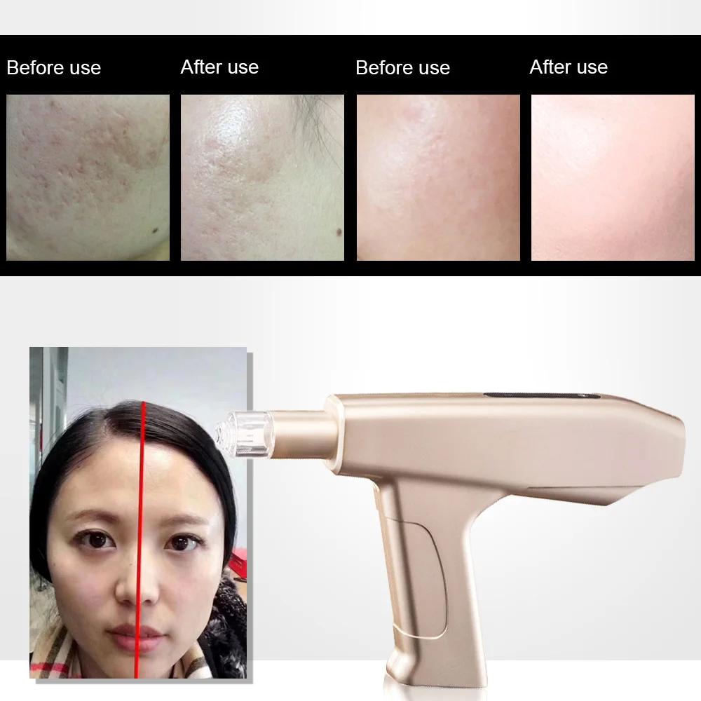 

SPA Microneedle Beauty Instrument Electric Facial Skin Hydrating Wrinkle Removal Anti-aging Import Instrument Skin Care Machine