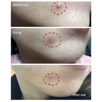 BREYLEE Acne Pimple Patch Stickers Acne Treatment Pimple Remover Tool Blemish Spot Facial Mask Skin Care Waterproof 22 Patches 5 BREYLEE Acne Pimple Patch Stickers Acne Treatment Pimple Remover Tool Blemish Spot Facial Mask Skin