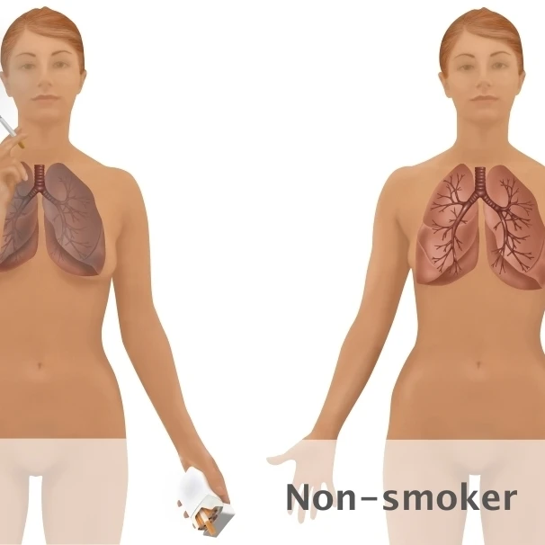 Lungs of Smoker vs. Non Smoker Poster Print by Gwen ShockeyScience