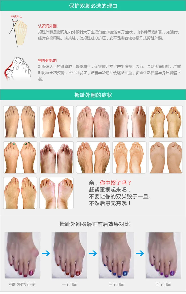 4 шт. hallux вальгусная seperating накладка на палец при бурсите гелевый, для пальцев ног сепараторы растягиватели Bunion протектор Выпрямитель Корректор для педикюра