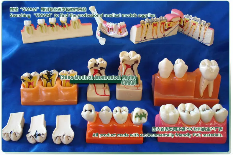 CMAM/12603 стоматологические кариес у детей, человеческие стоматологические медицинские анатомические модели обучения