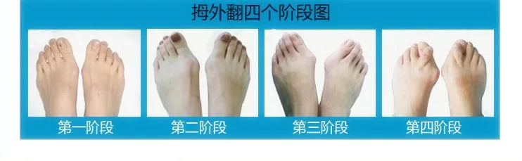 4 шт. hallux вальгусная seperating накладка на палец при бурсите гелевый, для пальцев ног сепараторы растягиватели Bunion протектор Выпрямитель Корректор для педикюра