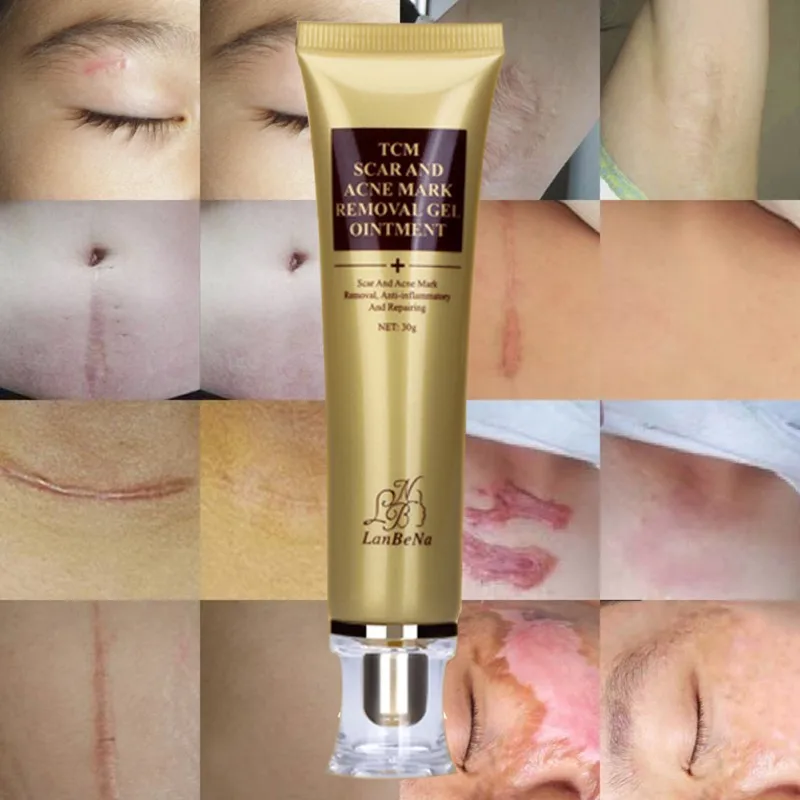 30 мл Beauty шрама крем Ремонт кожи крем для лица акне пятна лечение акне Черноголовых отбеливающий крем
