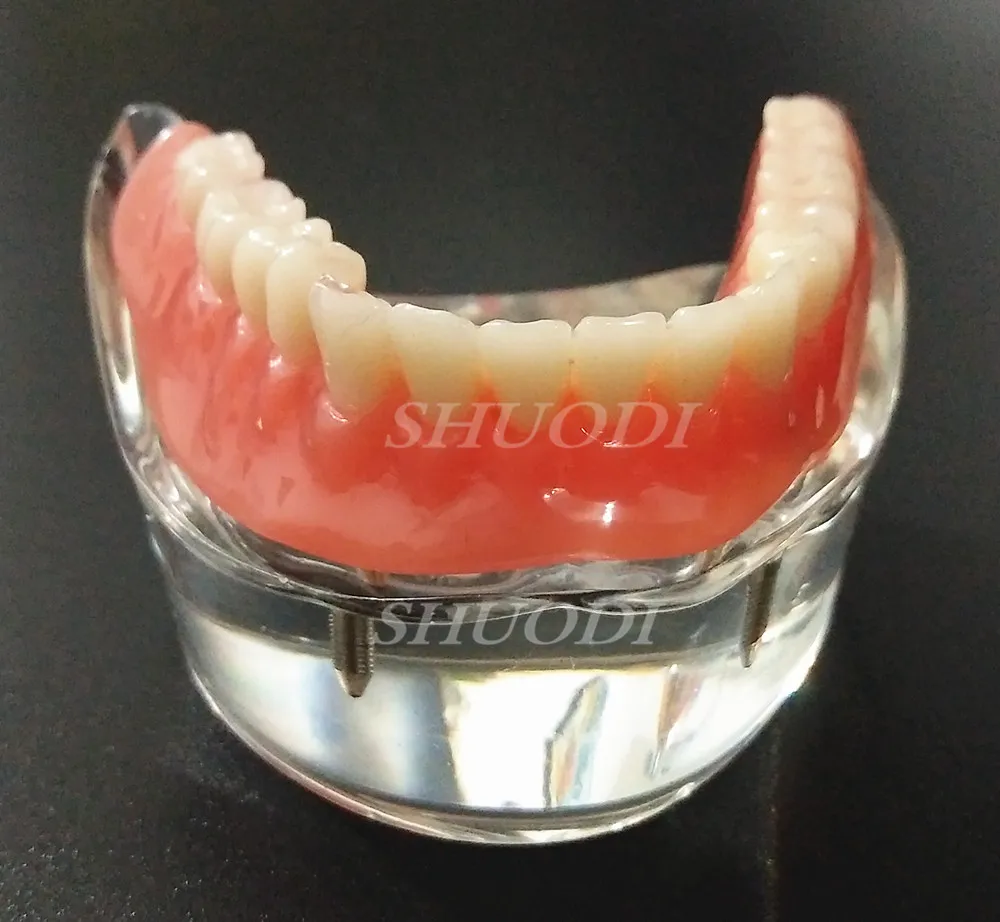 Стоматологическая Overdenture интерьер челюсти нижняя с 4 восстановления зубов обследование зубов Научите Модель