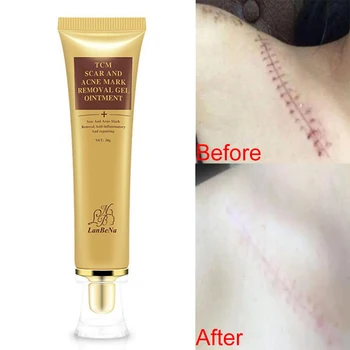 

MQ Useful 3Box Acne Scar Cream Skin Care Health Cream Chinese Spots Acne Repair For Face Body ACNE MARK REMOVAL GEL OINTMENT