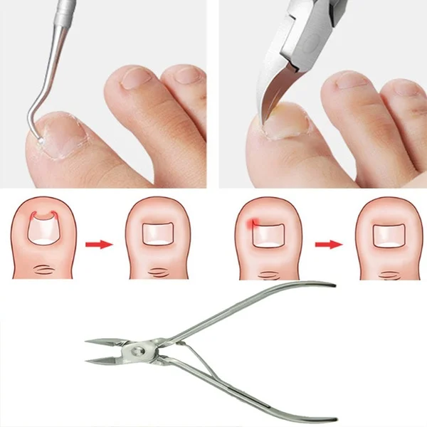 

Ingrown Foot Care Tool Toe Nail Correction Nippers Clipper Cutters Dead Skin Dirt Remover + Paronychia Podiatry Pedicure