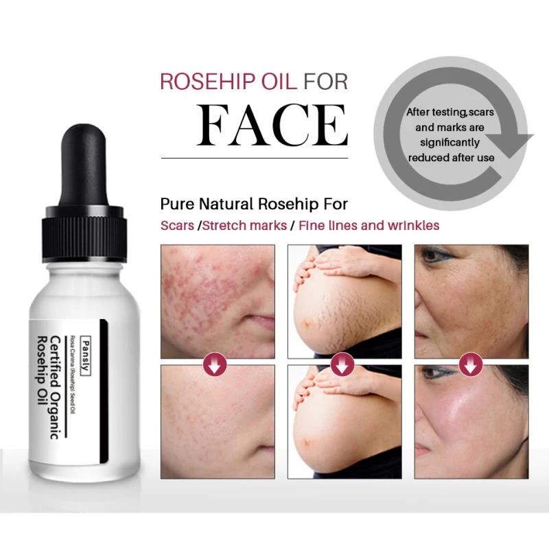 

10ml Rosehip Oil Stretch Marks Pregnancy Scar Remover Face Serum Whitening Moisturizer Acne Scar Removal Treatment Smooth Skin
