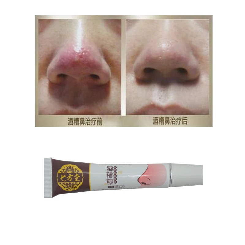 2 Packs Herbal Medicine Rosacea Treatment Red Nose Acne Rosacea