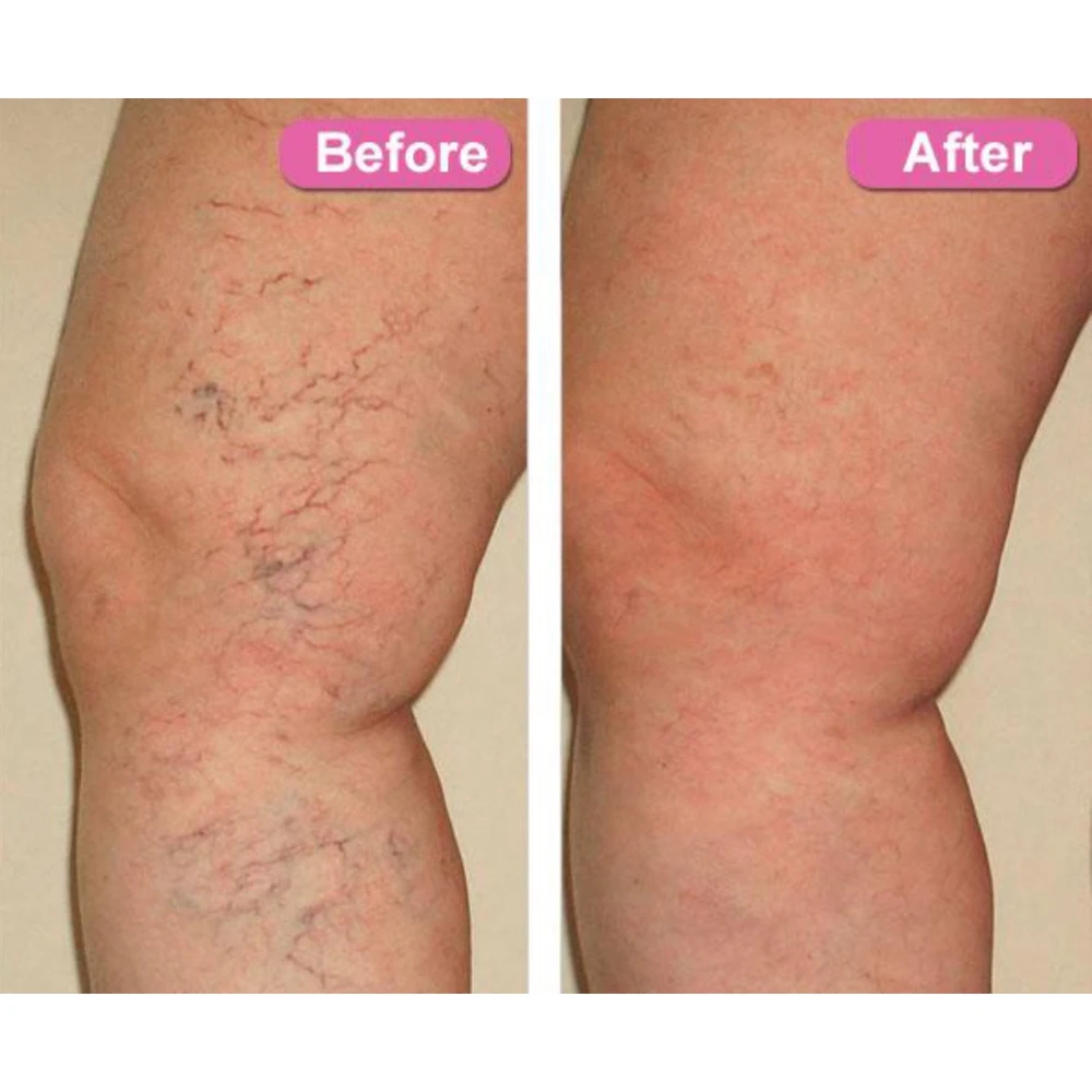 hemorrhoid cream for spider veins hemorrhoid cream for spider veins
