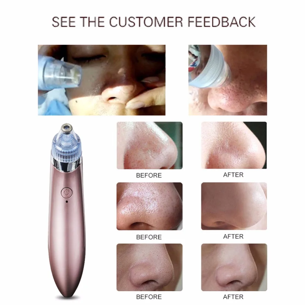 Facial Blackhead Remover Vacuum Dead Skin Acne Pore Peeling Device Cleaning Skin Tool Suck Out Blackhead 1 Facial Blackhead Remover Vacuum Dead Skin Acne Pore Peeling Device Cleaning Skin Tool Suck Out Blackhead 2