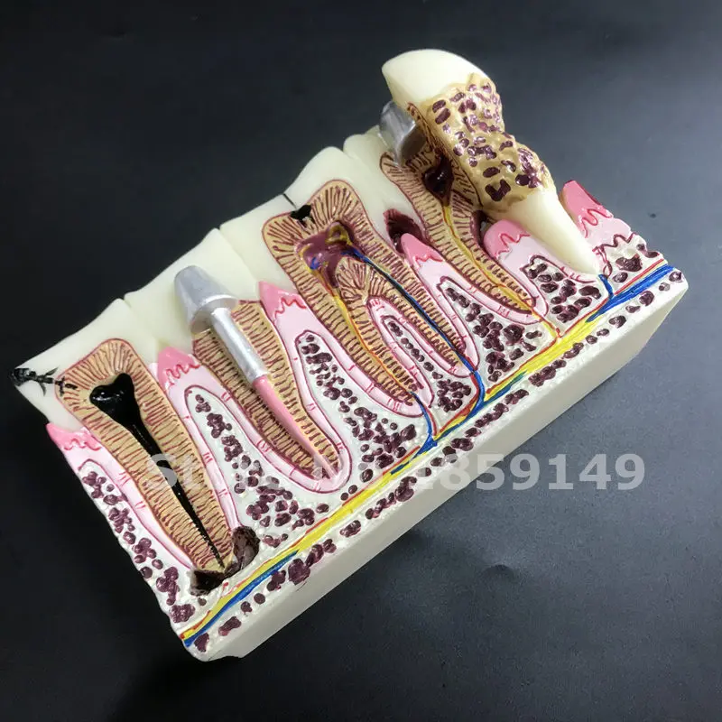Стоматологическая Анатомия стоматологических кариес пластиковые зубы модель демонстрационная связь