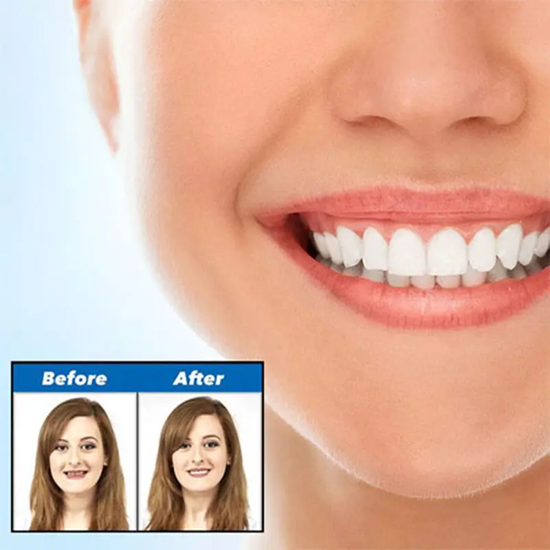 Виниры Perfect Smile профессиональная силиконовая коррекция плохих зубов отбеливание