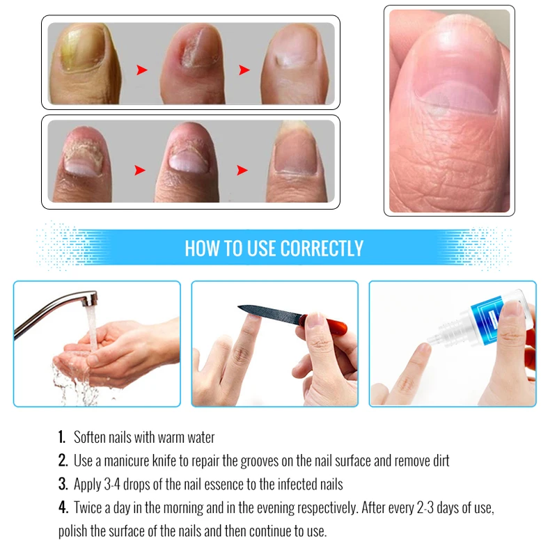 Omilady Высококачественная защита для ногтей эфирное масло для ухода за кожей крем для лечения грибка ногтей инструменты для ремонта ногтей