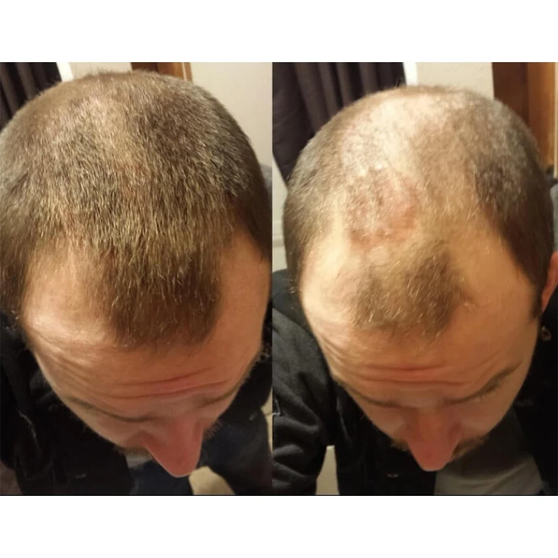 Sevich nozzle applicator pump for hair building fiber bottle 12g 25g 27.5g spray styling hair loss thicken uniform spray salon - Image 4