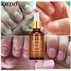 OEDO Healthy Nail Care Herbal Fungus Nail Repair Essential Oil Hand and Foot Bright White Toe Nail Remove Fungus Infected Nail ► Photo 2/6