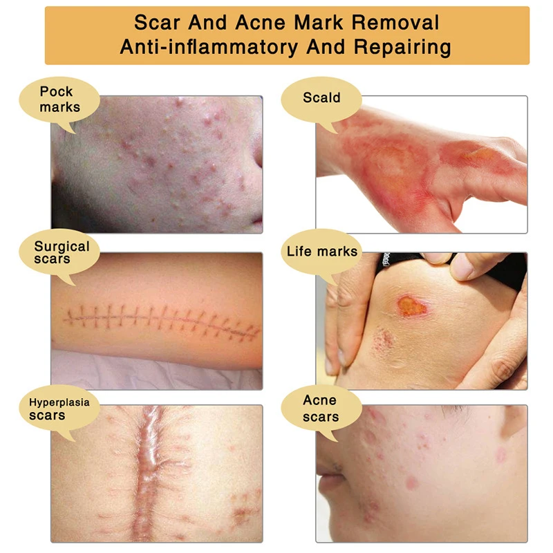 ALIVER гель для восстановления шрамов быстро удаляет различные келоидные марки, кремы для ухода за кожей, чтобы осветить тон кожи увлажняющий гель