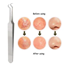 5 шт. экстрактор акне инструмент для удаления угрей иглы для удаления угрей удаление пятен Комедон очиститель пятен инструменты для удаления черных головок очиститель лица