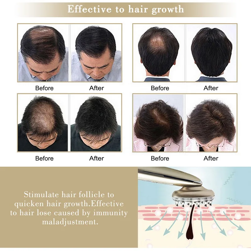 Us 4215 38 Offkonmison Anti Hair Loss Comb Rf Ems Nurse Led Photon Laser Stimulate Hair Regrowth Brush Head Scalp Repair Hair Massager In Hair