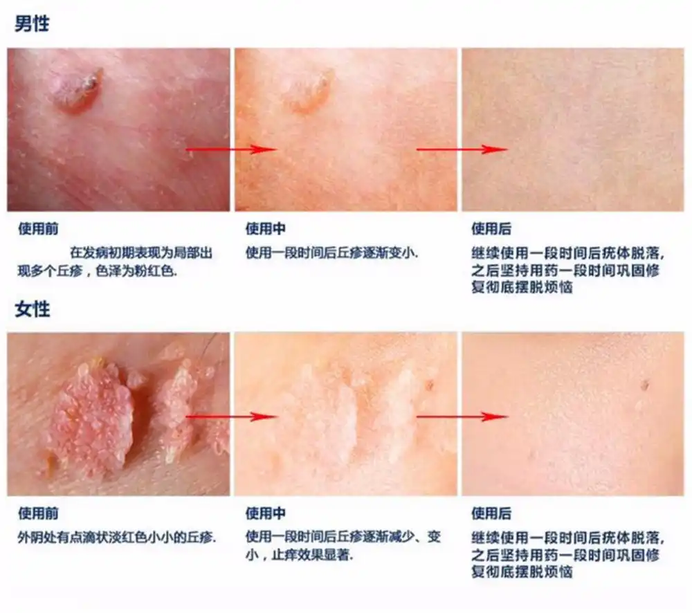 Get Woman Hpv Warts On Face PNG