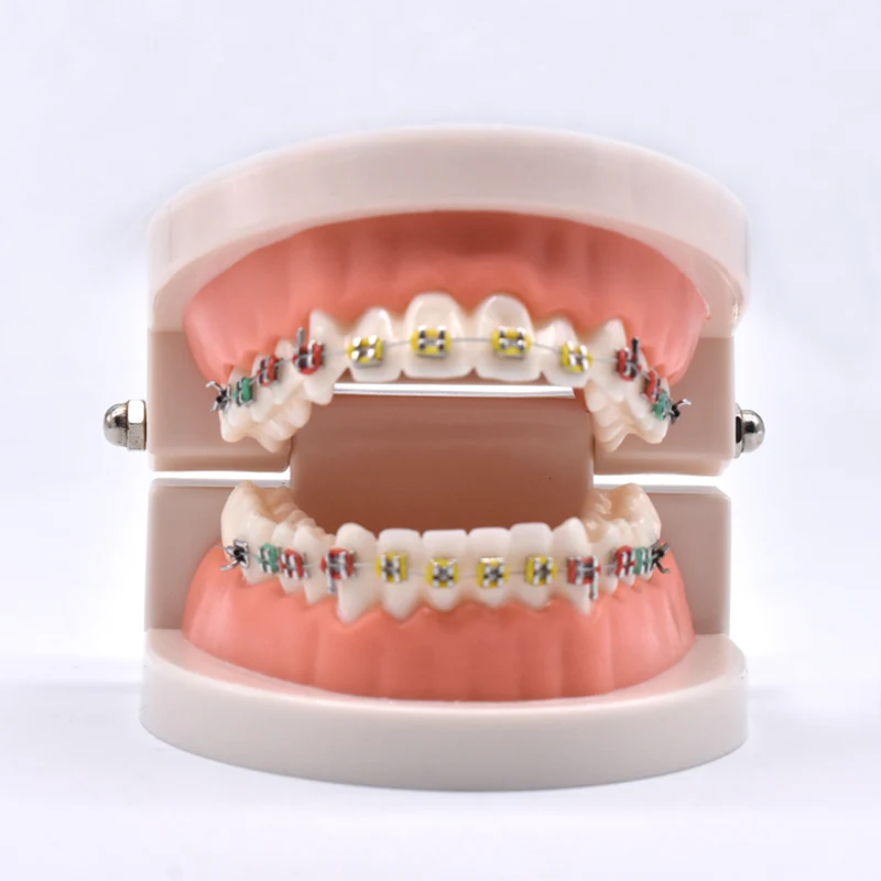 Dental Orthodontic Treatment Model With Ortho Metal ...