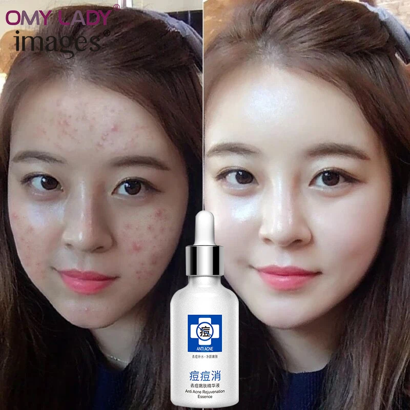 

OMY LADY IMAGES acne treatmnet essence acne spot remover serum natural&deep hydrating oil-control pure essence intensive face