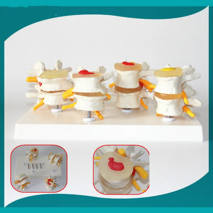 

Humans Skeleton Anatomical 4-stage Osteoporosis Vertebrae Anatomical Model Nursing Model Skin In Trauma Skeleton Spinal Anatomy