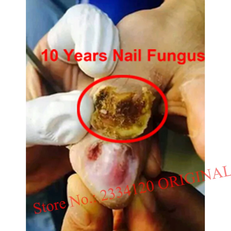Китайская медицина, Лечение грибка для пальцев ног, против грибковой инфекции ногтей, эссенция для лечения Ногтей, Уход за ногтями, лосьон