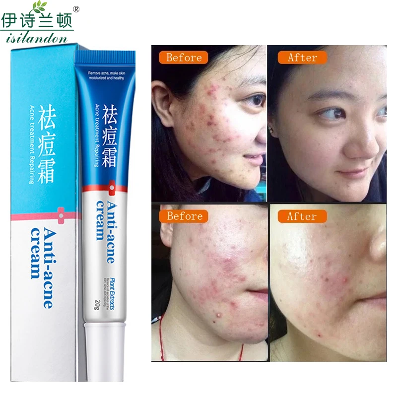 

ISILANDON 20g Acne Treatment Blackhead Remova Anti Acne Cream Oil Control Shrink Pores Acne Scar Remove Face Care Whitening