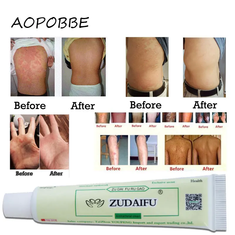 

AOPOBBE 1pcs zudaifu Body Psoriasis Cream Psoriasis Ointment Facial Cleansing
