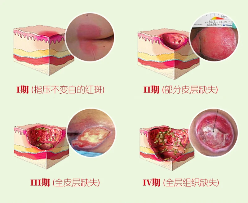 Травяное удаление гноя миогенный крем пролежни паста лечение давления язвы давление язвы заживление фестерных ран