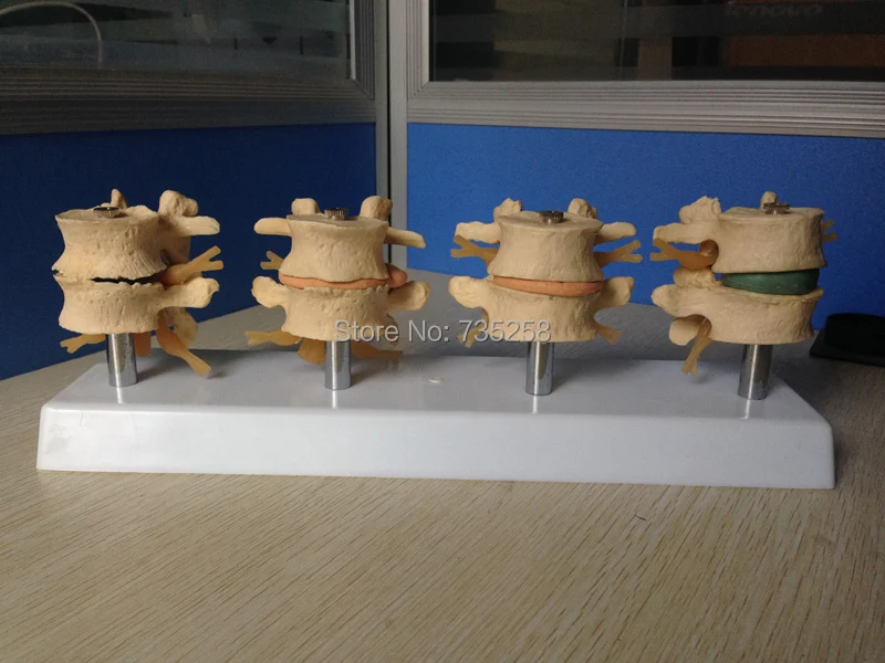 

Lumbar spine lesions presentation model ,Intervertebral disc model ,Lumbar spine model