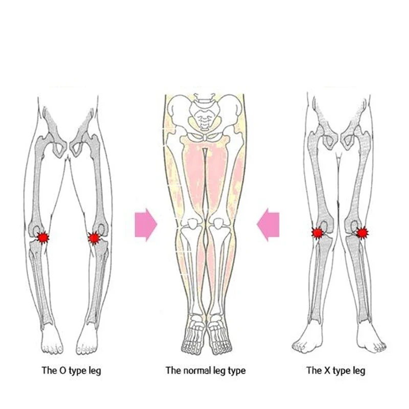 YAGEN новая осанка доступна на весь день O/X Тип ноги смычковые ноги колено Valgum выпрямление корректирующие ремни Группа Корректор осанки