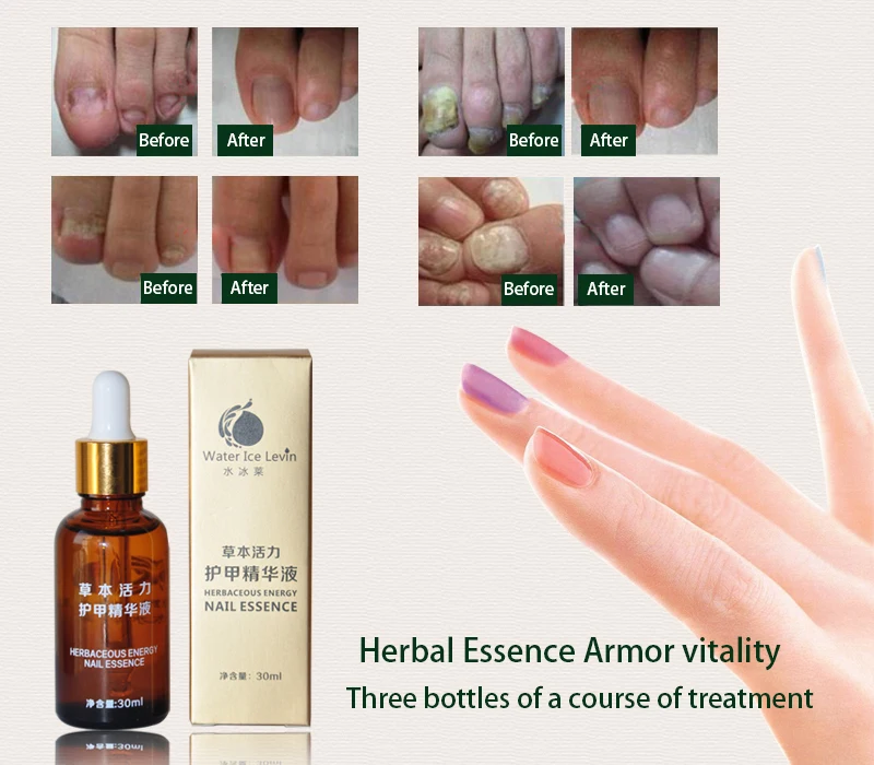 1 Bottle 30ml Anti-fungal Effective Toe Treatment Essence Oil Feet Care Nail Polish Removal Onychomycosis TSLM2