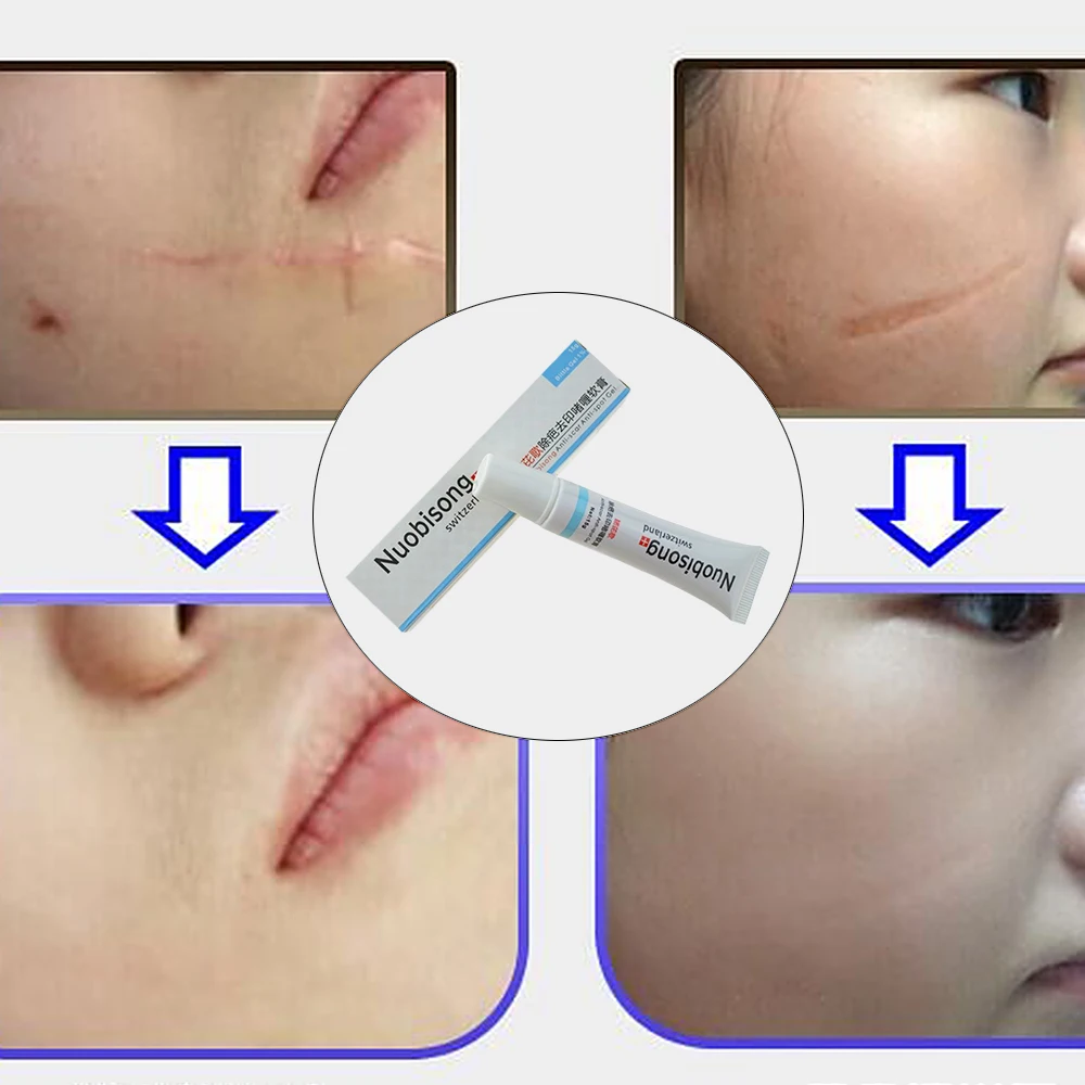 

Super Nuobisong Remove Scar Cream Remove Acne Spots Remove Striae Gravidarum Pigmentation Corrector Anti-Aging Moisturizing 15ml